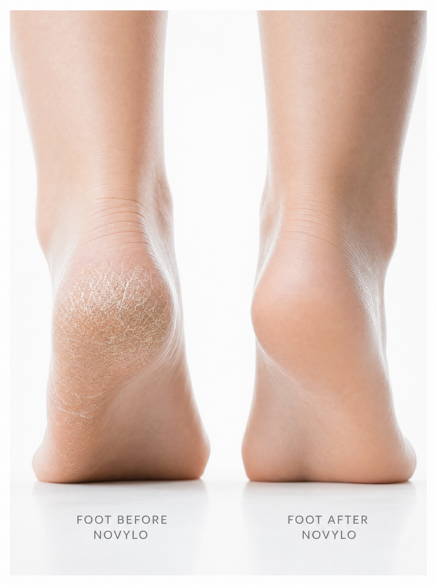 Novylo Velvet Pro™ — Electric Callus Remover | Rechargeable Foot File