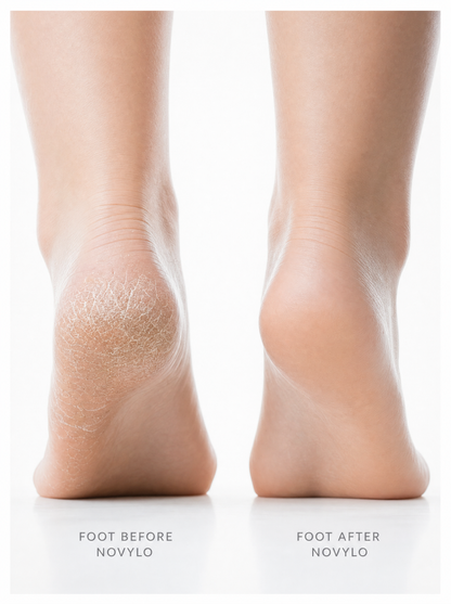 Novylo Velvet Pro™ — Electric Callus Remover | Rechargeable Foot File